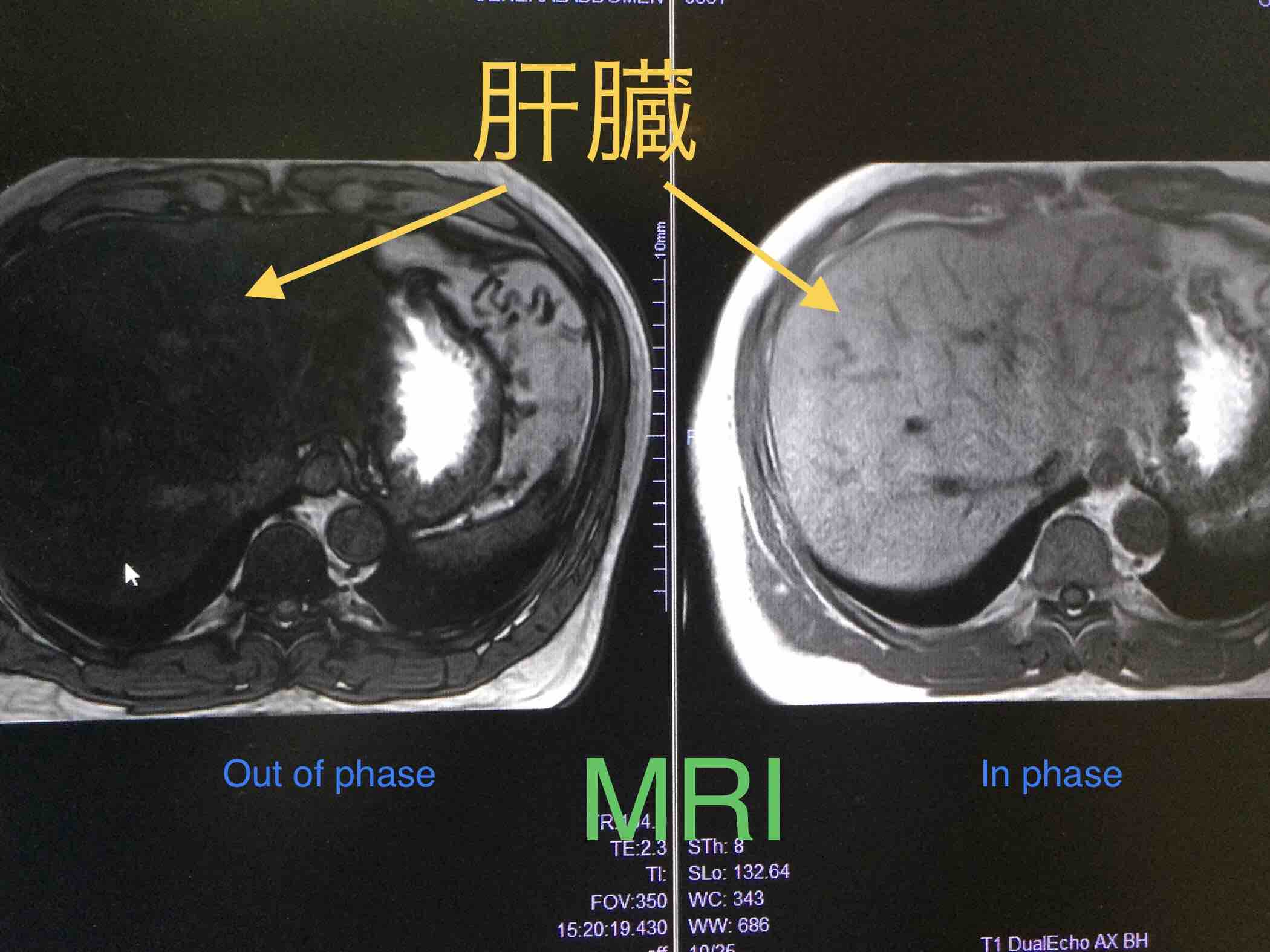 脂肪肝はMRIやCTでわかるのか？】 - 四日市消化器病センター